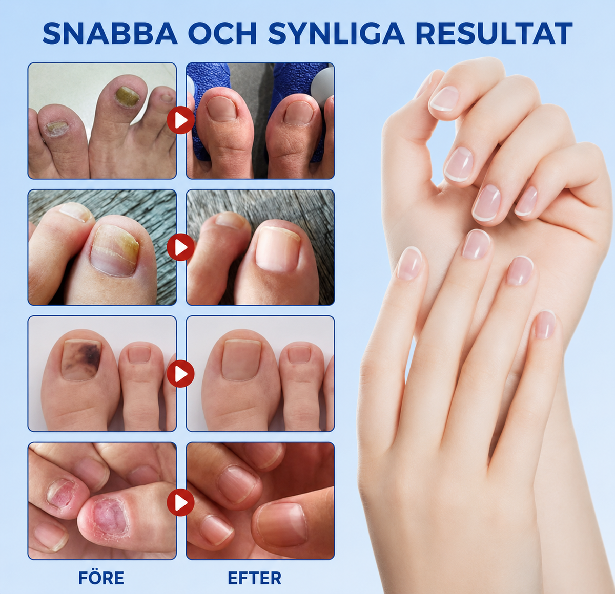 Behandlingsplåster mot nagelsvamp – snabbverkande behandling för friska naglar