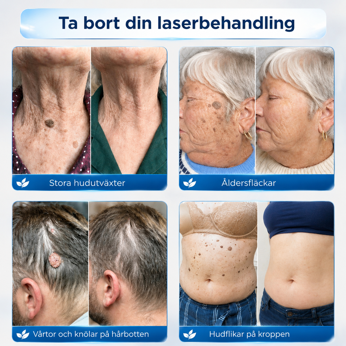 Riktad applicering för hudflikar och vårtor